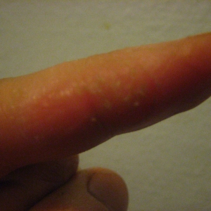 contact dermatitis?